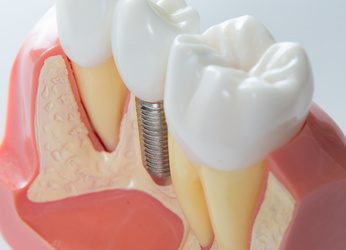 Close up of a Dental  implant model. Selective focus.